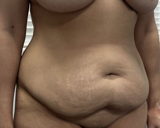 Tummy Tuck (Abdominoplasty): Case 562 - Before