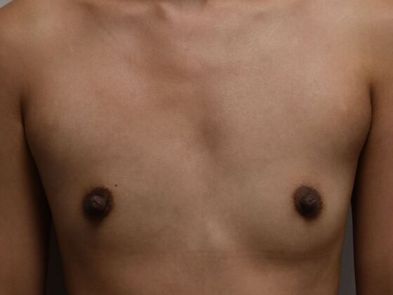 Breast Augmentation: Case 31 - Before