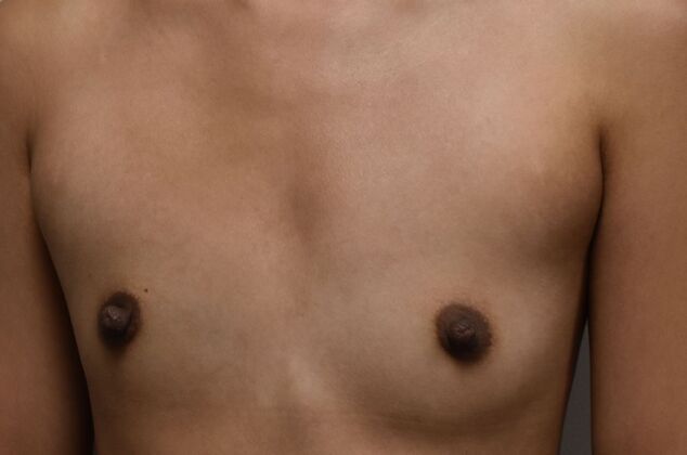 Breast Augmentation: Case 31 - Before