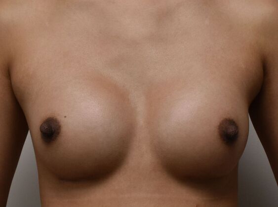 Breast Augmentation: Case 31 - After