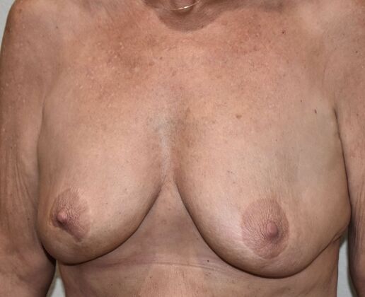 Breast Augmentation w/ Lift: Case 98a - Before