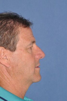 Rhinoplasty: Crooked nose with a bump in a man - Before