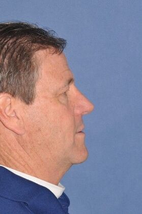 Rhinoplasty: Crooked nose with a bump in a man - After 1 year