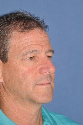 Rhinoplasty: Crooked nose with a bump in a man - Before