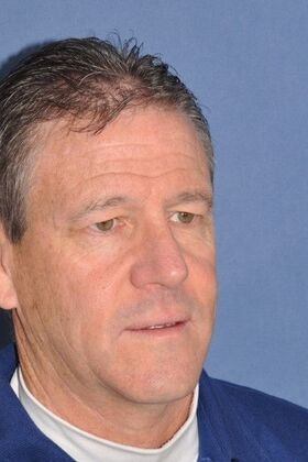 Rhinoplasty: Crooked nose with a bump in a man - After 1 year