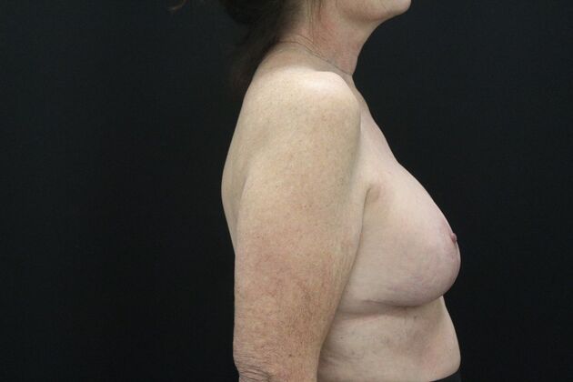 Breast Lift/Breast Lift Augmentation: Case 71 - After
