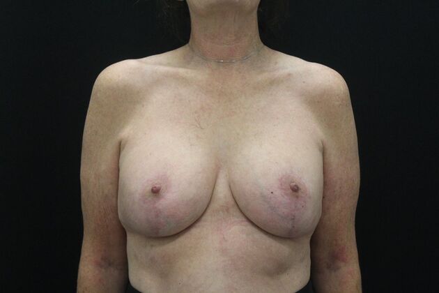 Breast Lift/Breast Lift Augmentation Case 71 - After