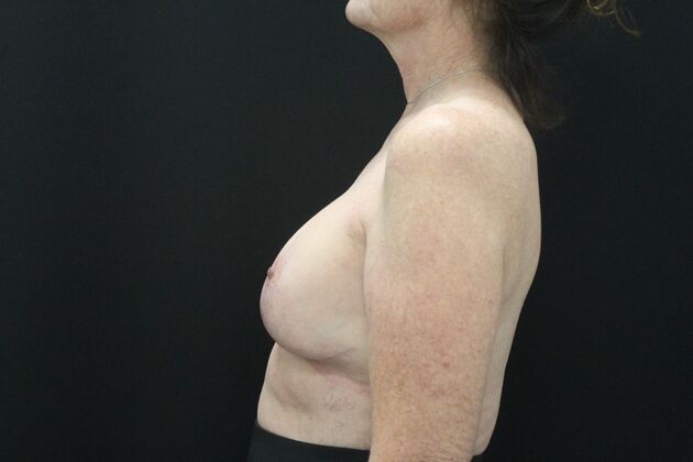 Breast Lift/Breast Lift Augmentation: Case 71 - After