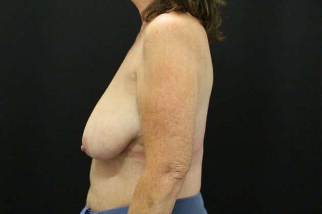 Breast Lift/Breast Lift Augmentation: Case 71 - Before