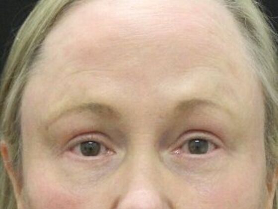 Forehead & Brow Lifts Case 9 - After