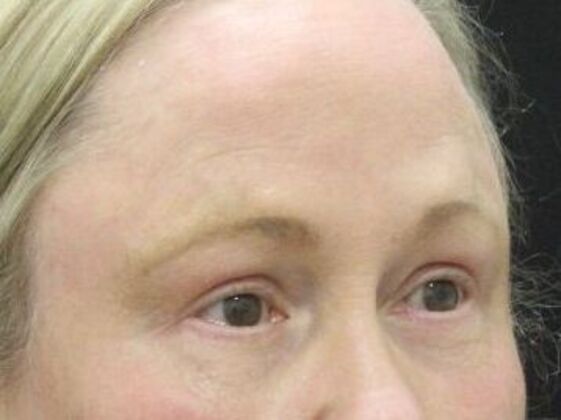 Forehead & Brow Lifts: Case 9 - After