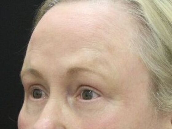Forehead & Brow Lifts: Case 9 - After