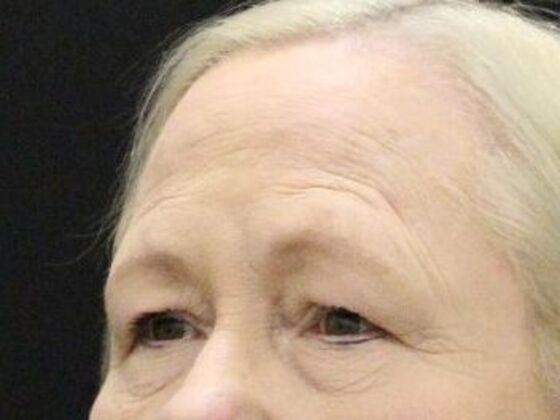 Forehead & Brow Lifts: Case 9 - Before