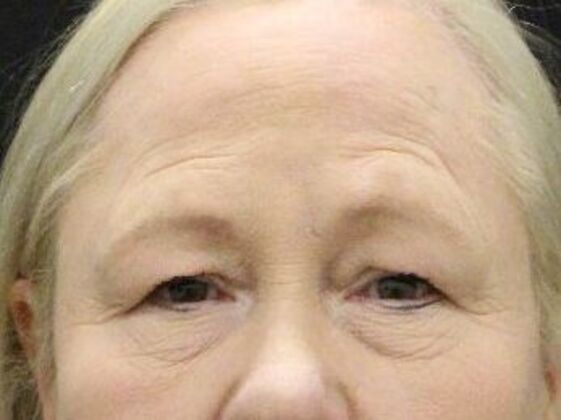 Forehead & Brow Lifts Case 9 - Before