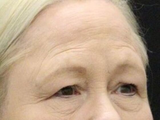 Forehead & Brow Lifts: Case 9 - Before