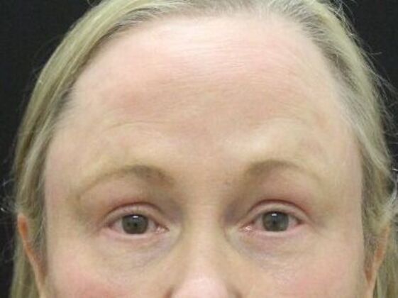 Eyelid Surgery Case 26 - After