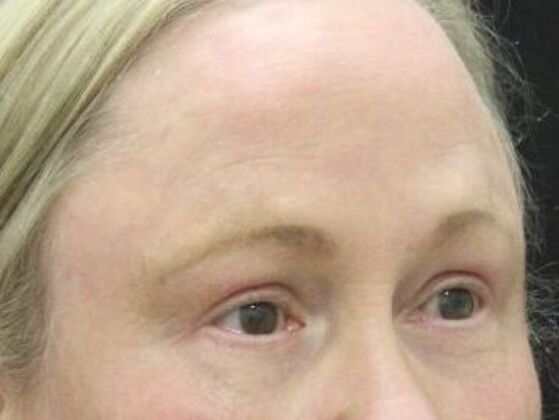 Eyelid Surgery: Case 26 - After