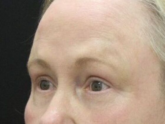 Eyelid Surgery: Case 26 - After