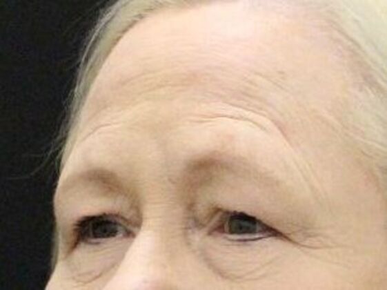 Eyelid Surgery: Case 26 - Before