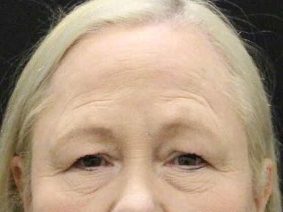 Eyelid Surgery Case 26 - Before