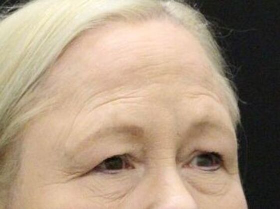 Eyelid Surgery: Case 26 - Before