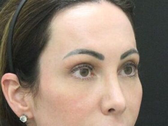 Eyelid Surgery: Case 27 - After