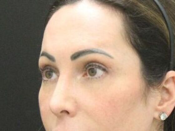 Eyelid Surgery: Case 27 - After