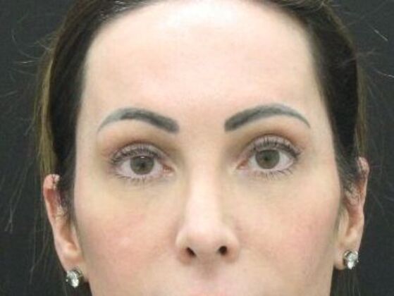 Eyelid Surgery Case 27 - After