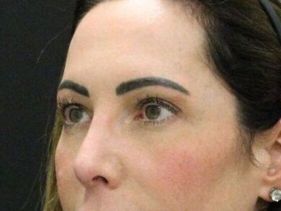 Eyelid Surgery: Case 27 - Before