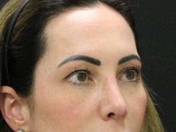 Eyelid Surgery: Case 27 - Before