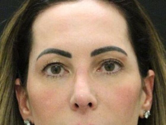 Eyelid Surgery Case 27 - Before