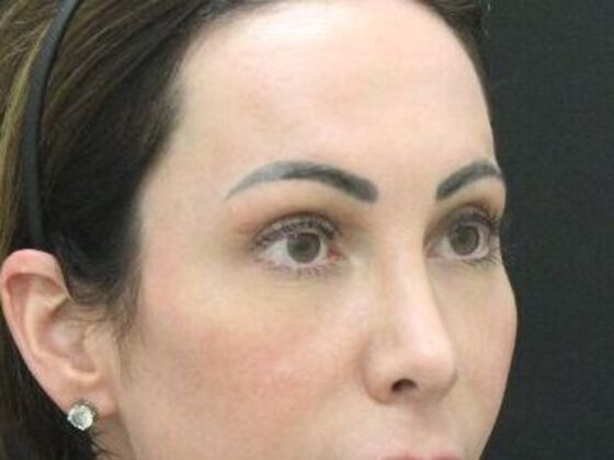 Forehead & Brow Lifts: Case 10 - After