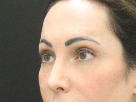 Forehead & Brow Lifts: Case 10 - After