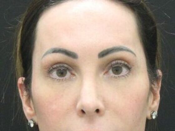 Forehead & Brow Lifts Case 10 - After