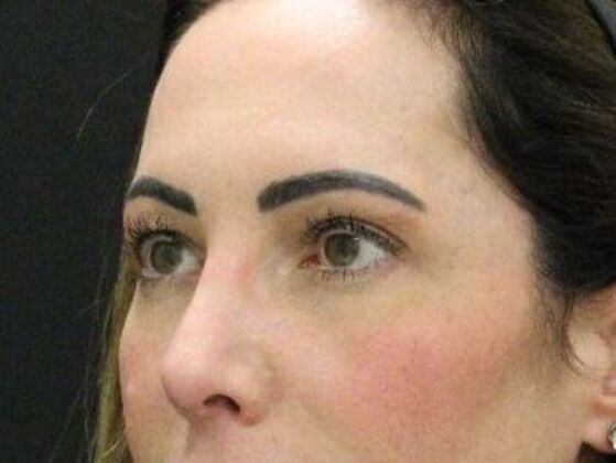 Forehead & Brow Lifts: Case 10 - Before