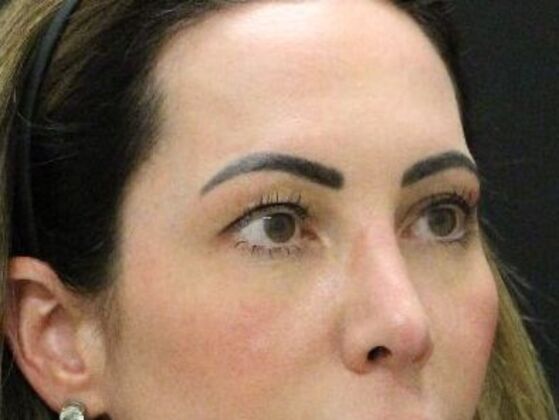 Forehead & Brow Lifts: Case 10 - Before