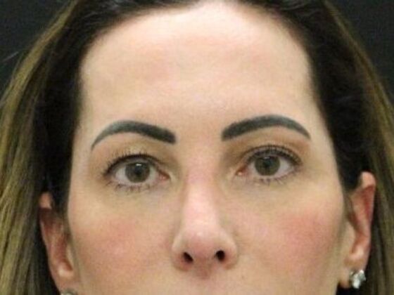 Forehead & Brow Lifts Case 10 - Before