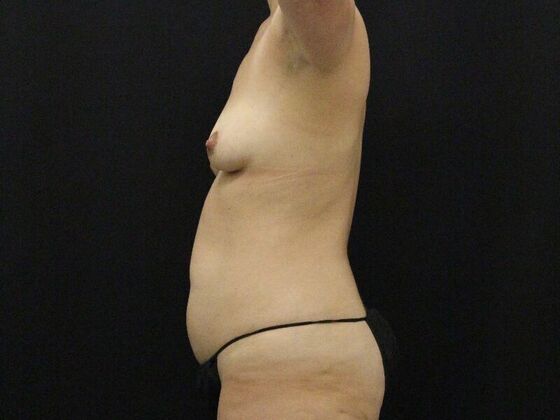 Liposuction: Case 44 - Before