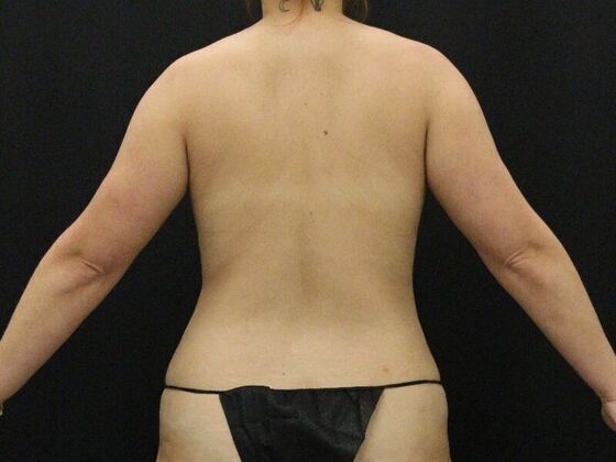 Liposuction: Case 44 - Before