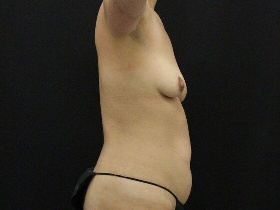 Liposuction: Case 44 - Before