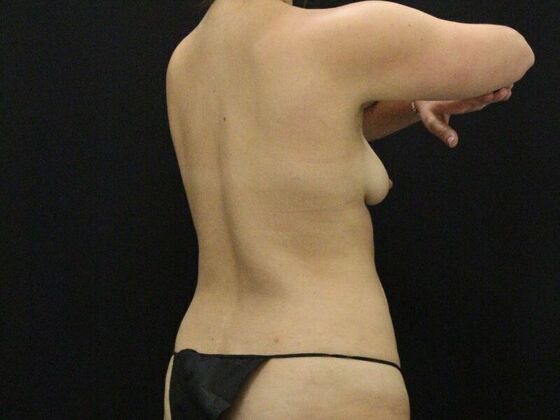 Liposuction: Case 44 - Before