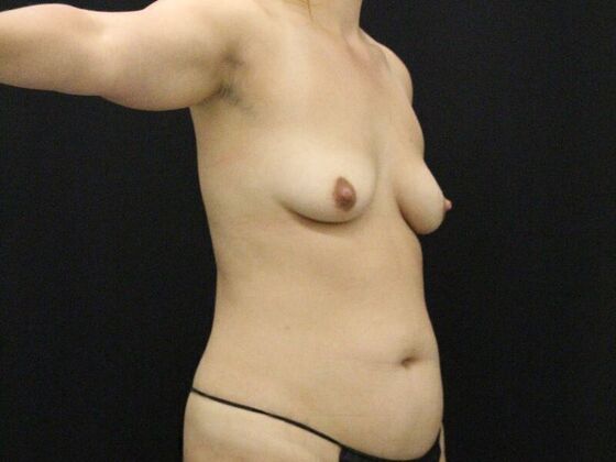 Liposuction: Case 44 - Before