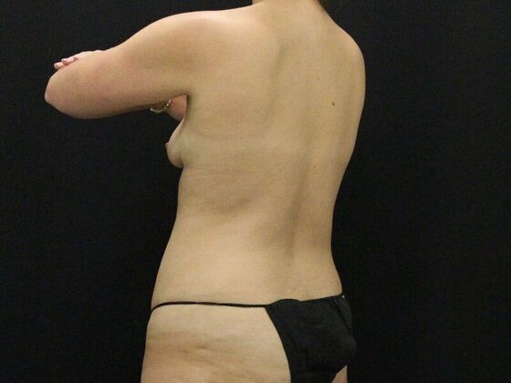 Liposuction: Case 44 - Before