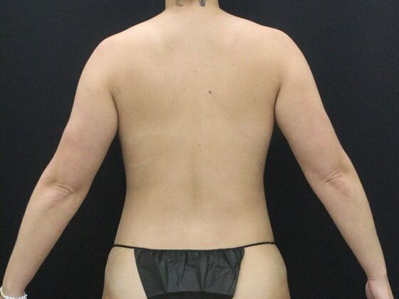Liposuction: Case 44 - After