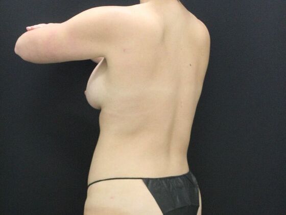Liposuction: Case 44 - After