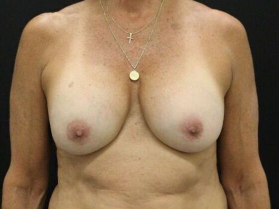 Breast Augmentation Exchange/Revision Case 28 - Before