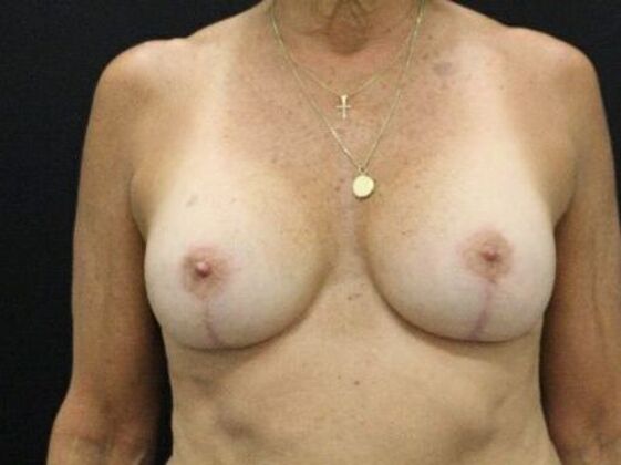 Breast Augmentation Exchange/Revision Case 28 - After
