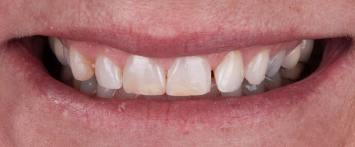 Smile Makeover & Veneers: Lauralee - Before