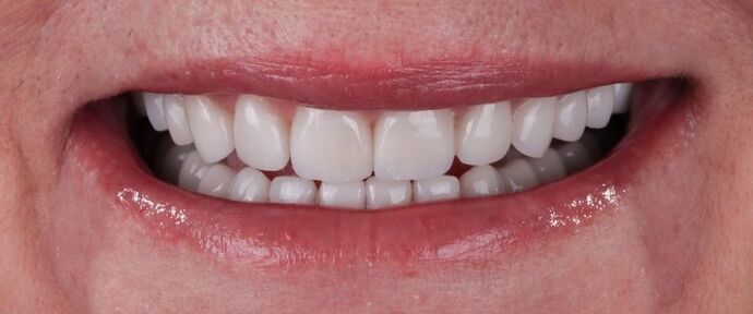 Smile Makeover & Veneers: Lauralee - After