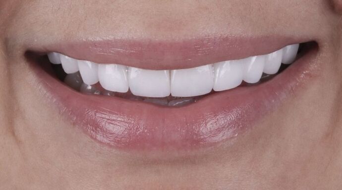 Smile Makeover & Veneers: Sammy. - After